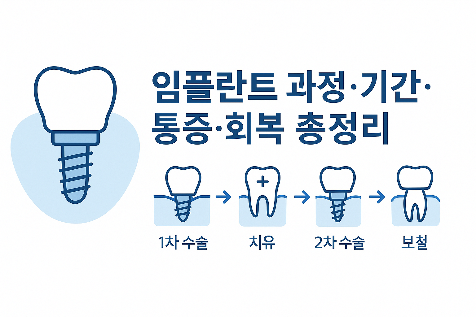 임플란트 과정·기간·통증·회복 총정리 – 1차 수술부터 보철·음식 관리까지